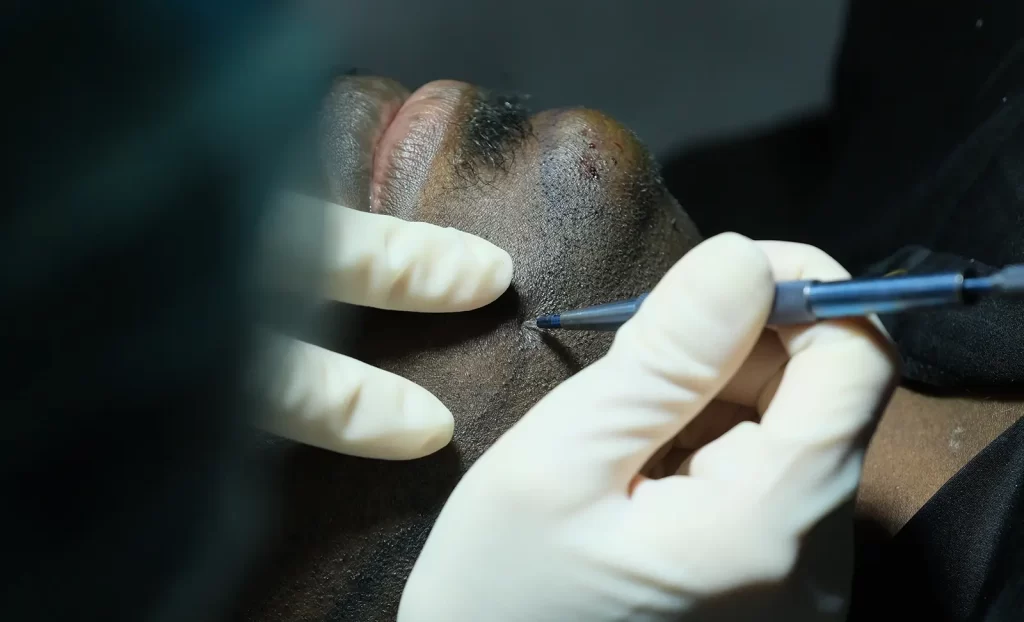 Beard Transplant