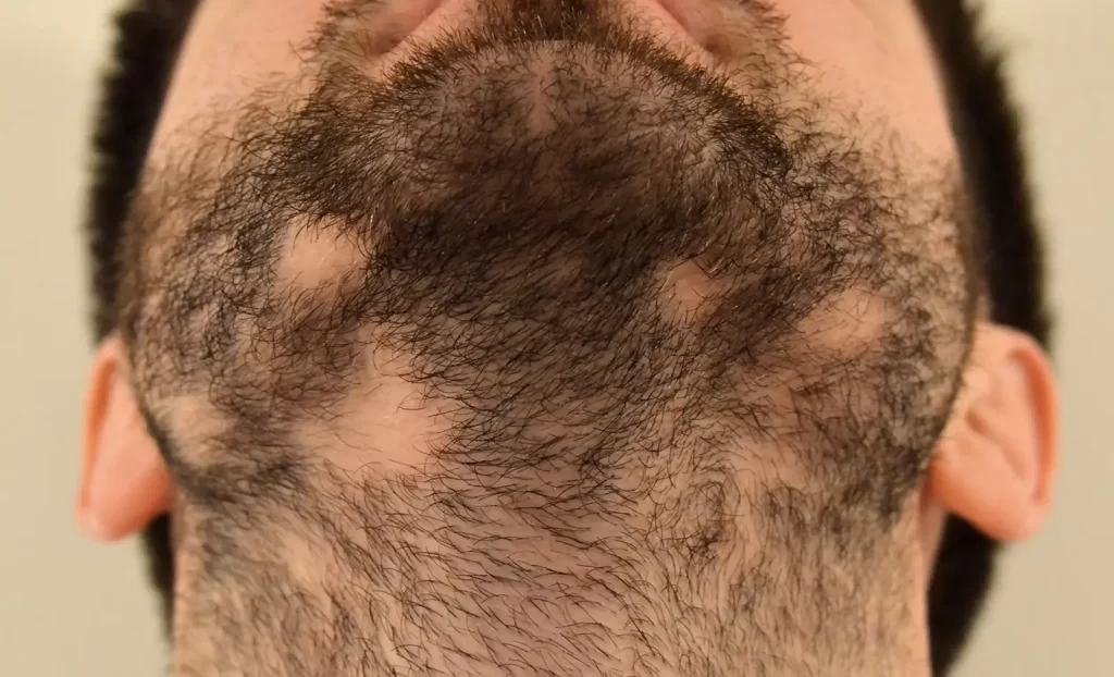 Alopecia Barbae on beard