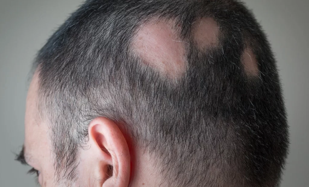 alopecia aerata bald spots
