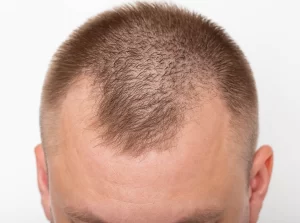 Bell Curve male hairline