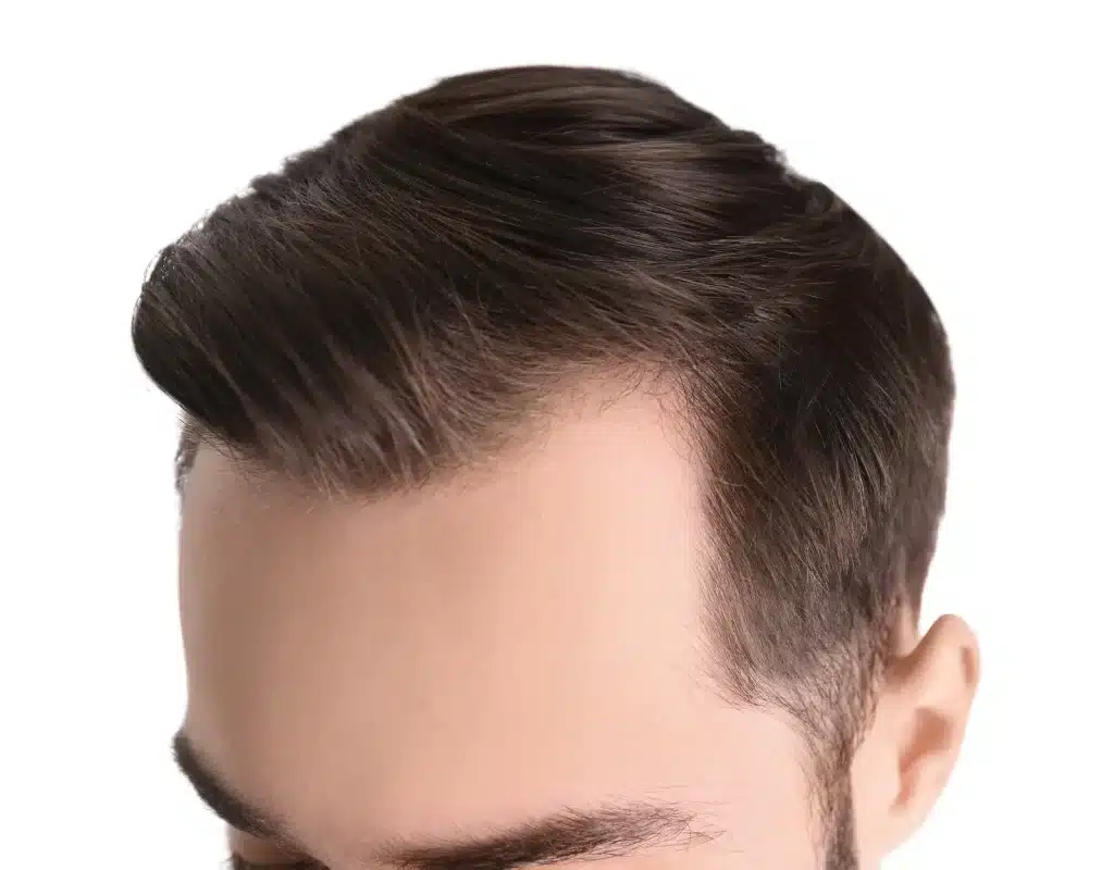 M shape male hairline
