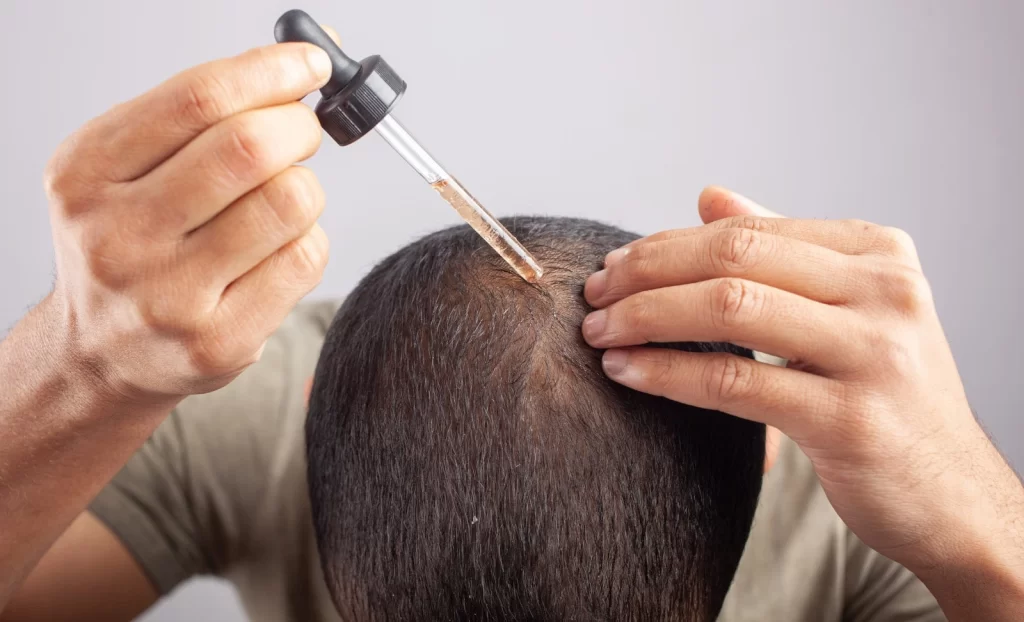 minoxidi oil for hair loss