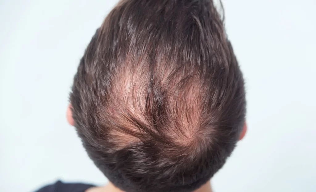 Male pattern baldness crown