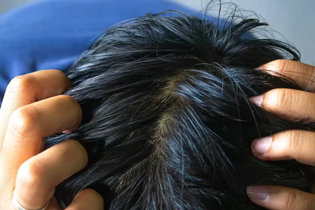Pumpkin Seed oil for male hair loss