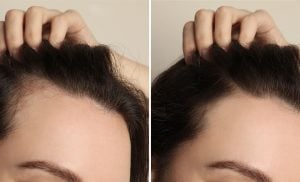 Hair growth medication women