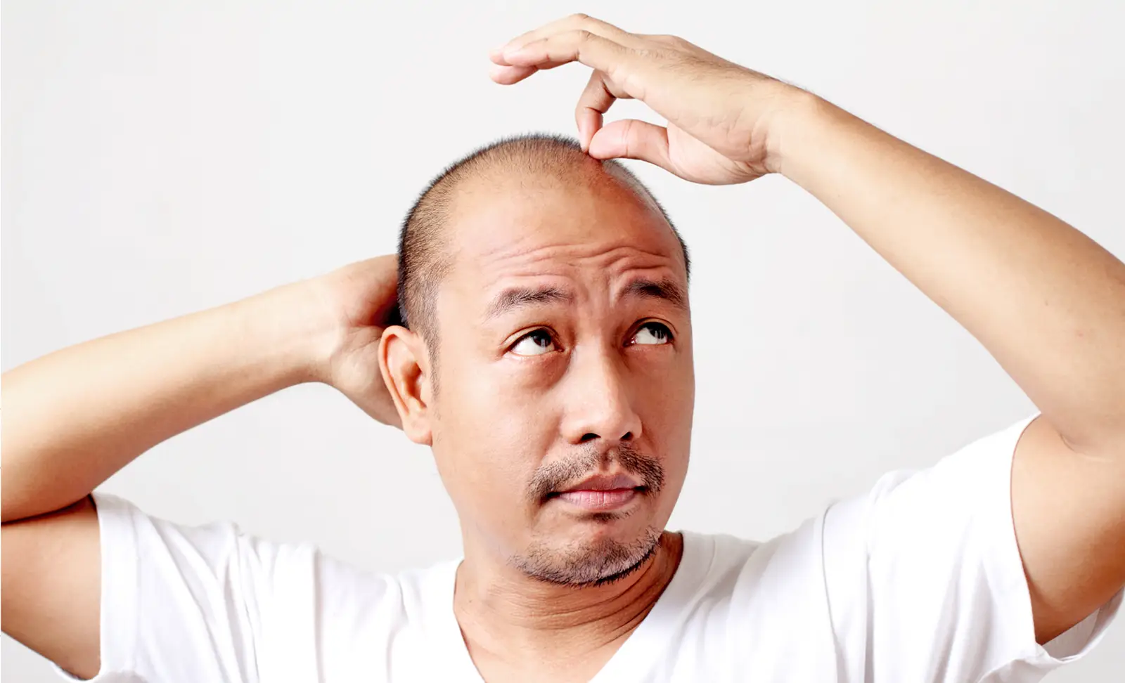 Asian hair loss - balding men