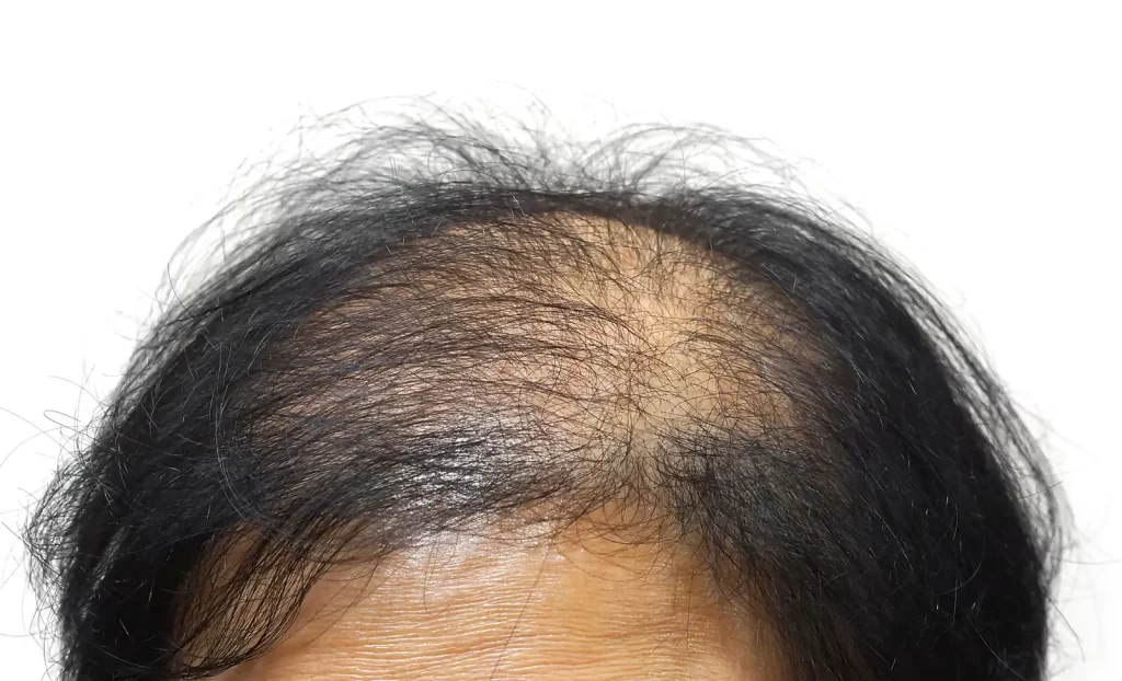 Thinning asian hair