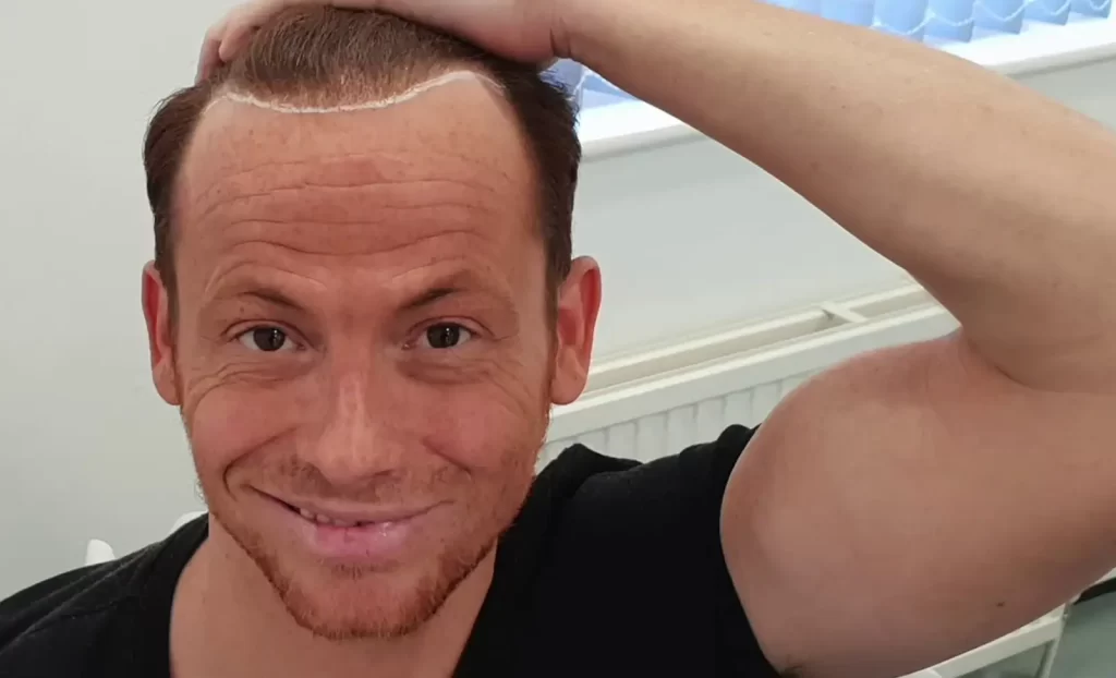 Joe Swash before hair transplant