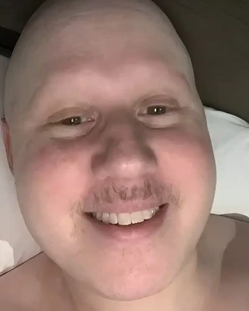 Matt Lucas hair loss