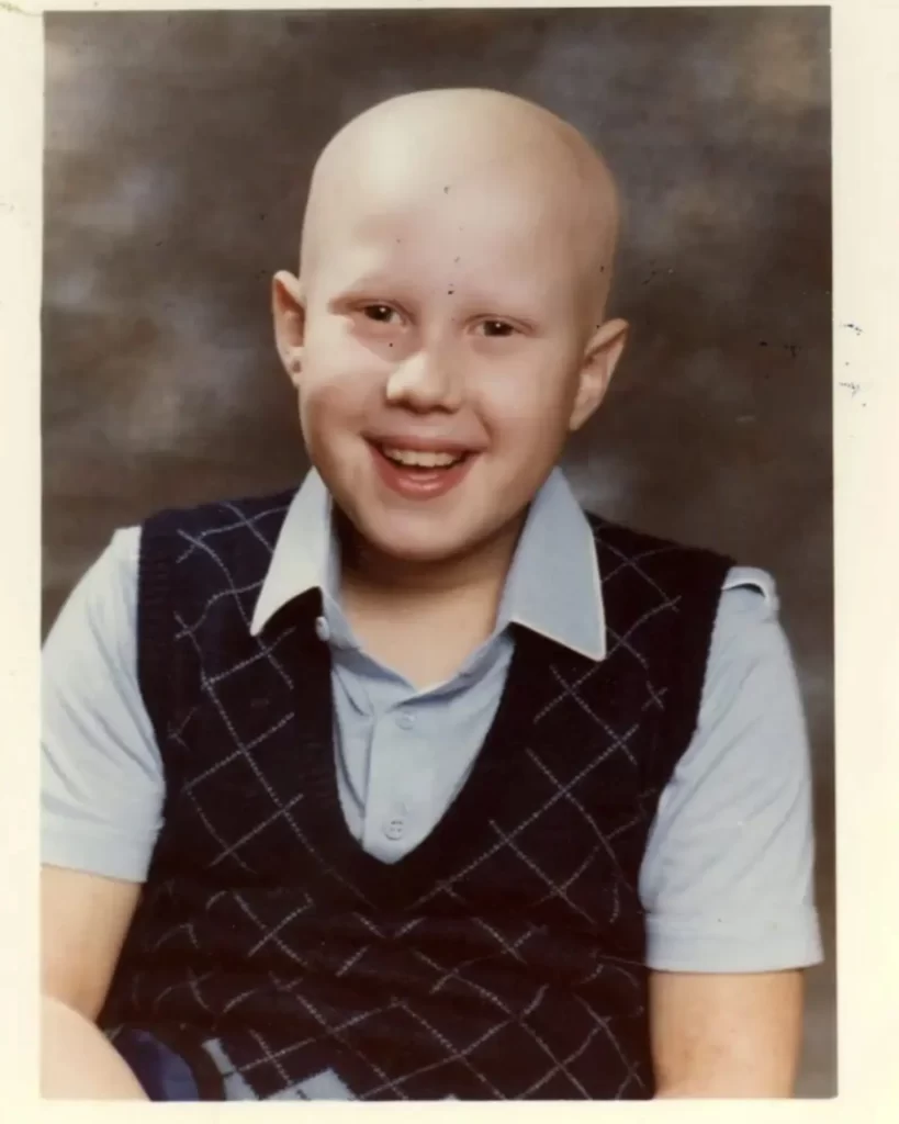 Matt Lucas hair loss child