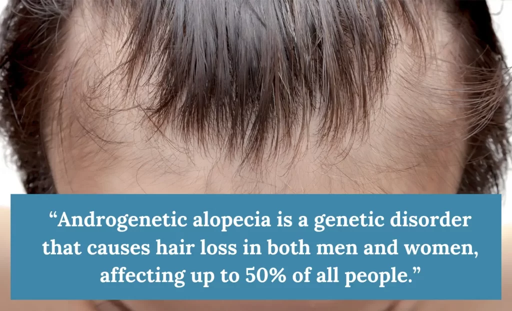 Androgenetic alopecia 