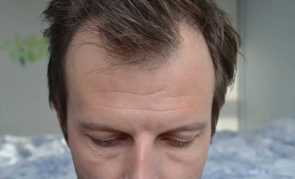 close up of Telogen Effluvium