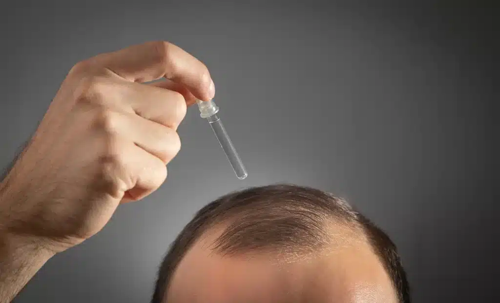 Minoxidil hair loss