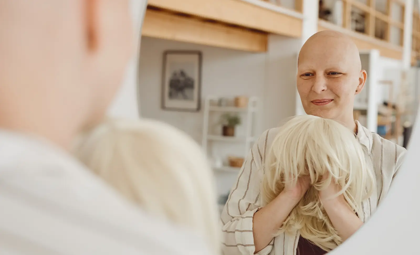 Can Alopecia be treated on the NHS