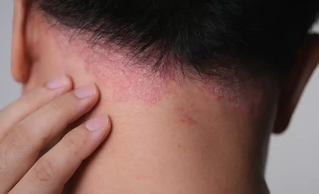 Scalp Psoriasis 