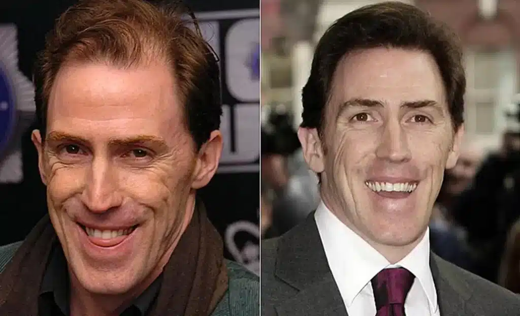 Rob Brydon hair transplant before and after
