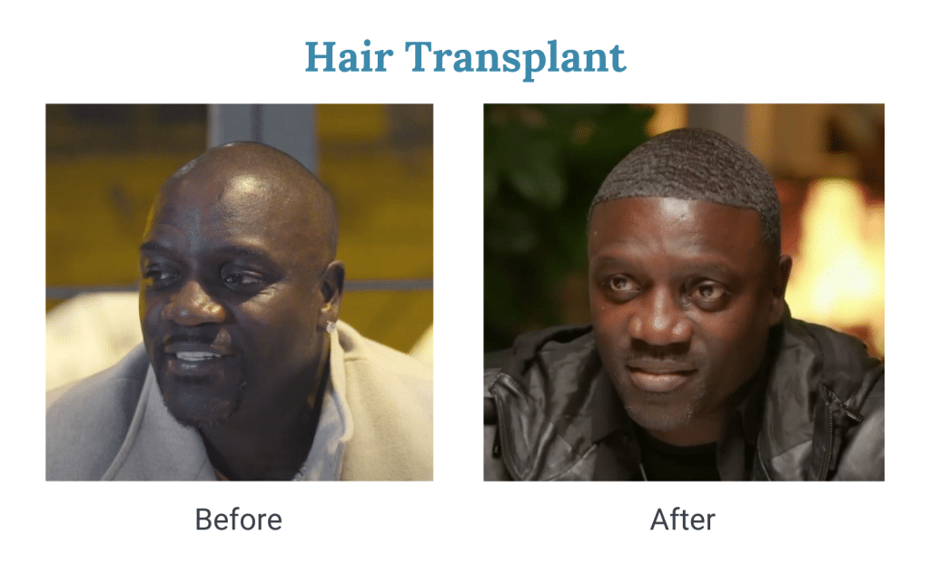 Akon hair transplant before and after