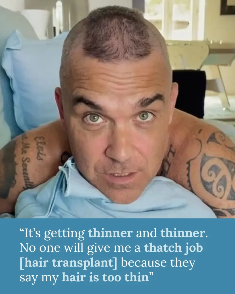 Robbie Williams - hair thinning