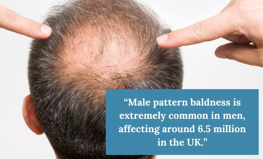 male pattern baldness