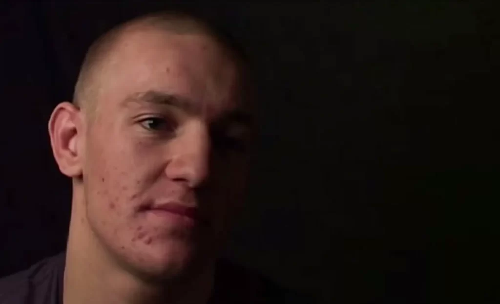 Conor McGregor pre Hair Transplant