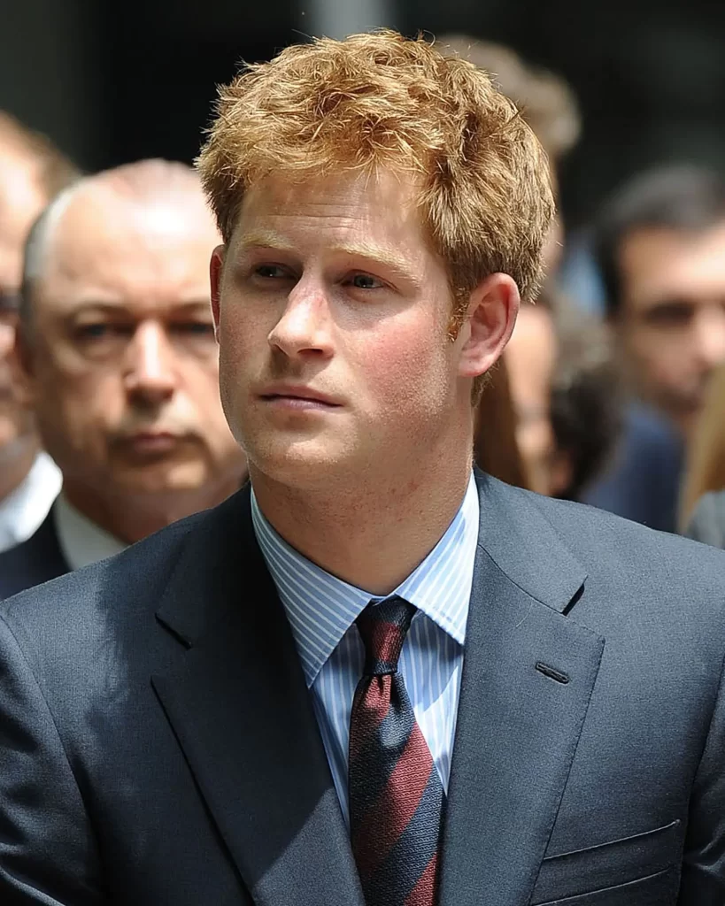 Prince Harry before Hair Transplant 