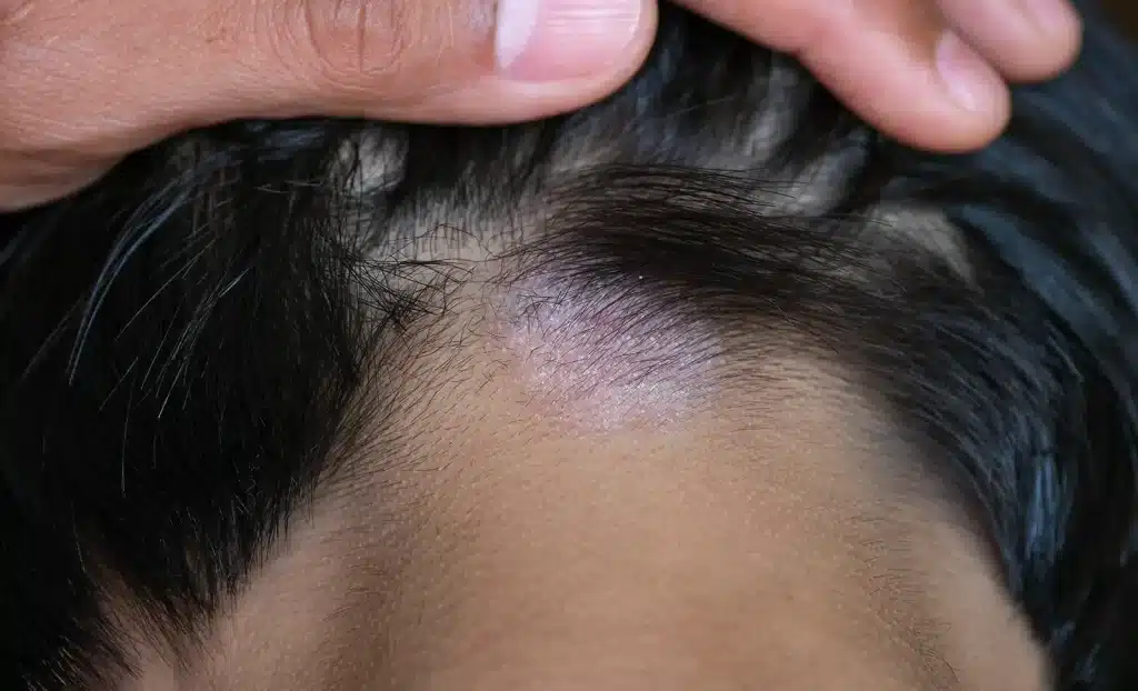 ringworm on the scalp