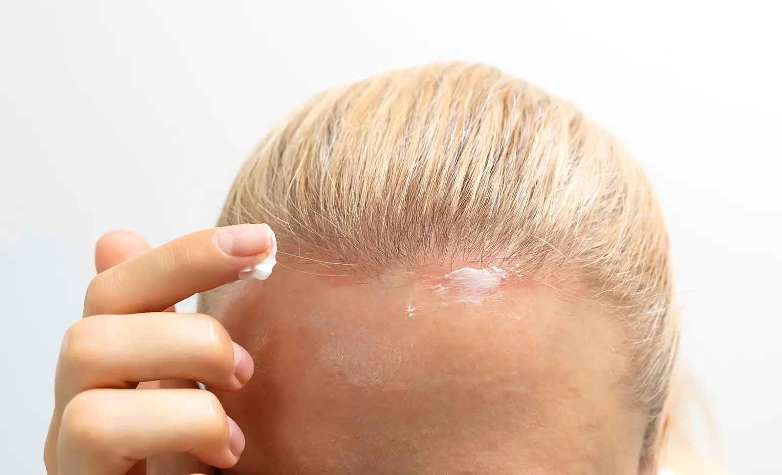 Causes and Treatments for Tender Scalps