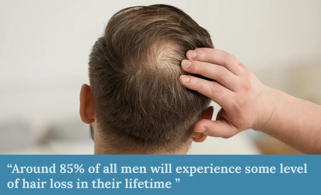 Male hair loss