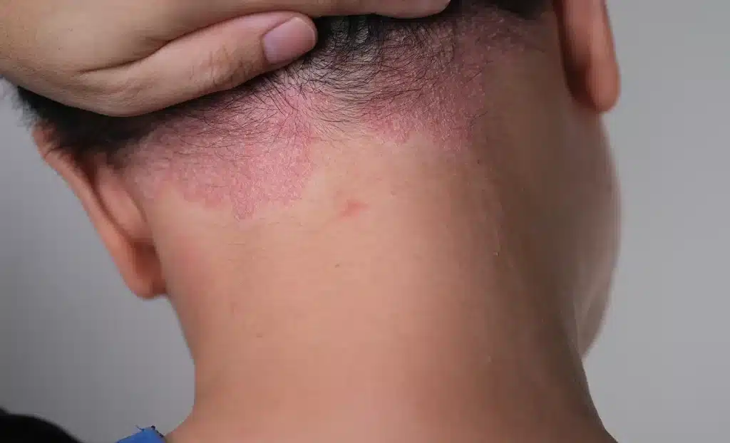 Scalp Psoriasis