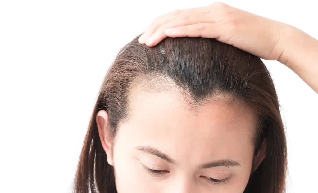 Receding hairline female