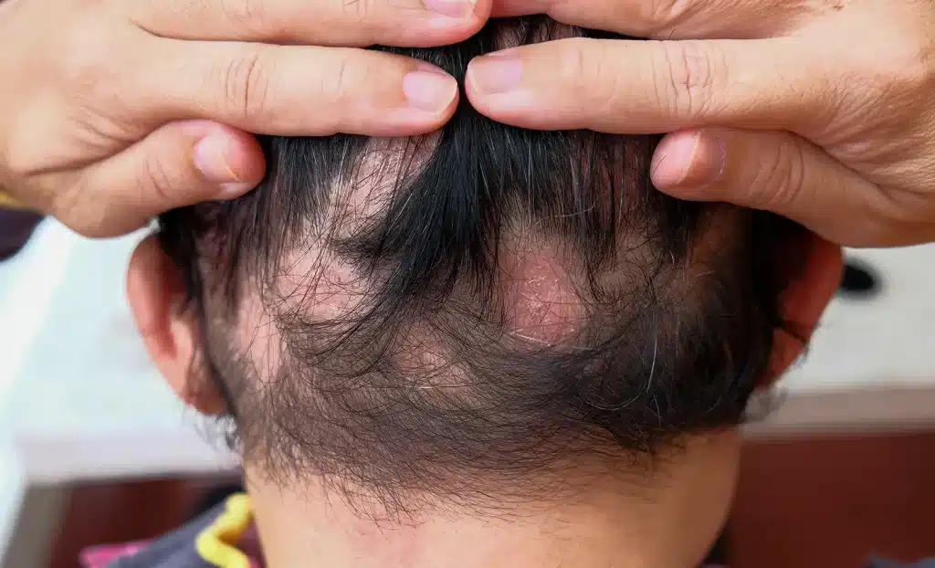 Alopecia Areata 