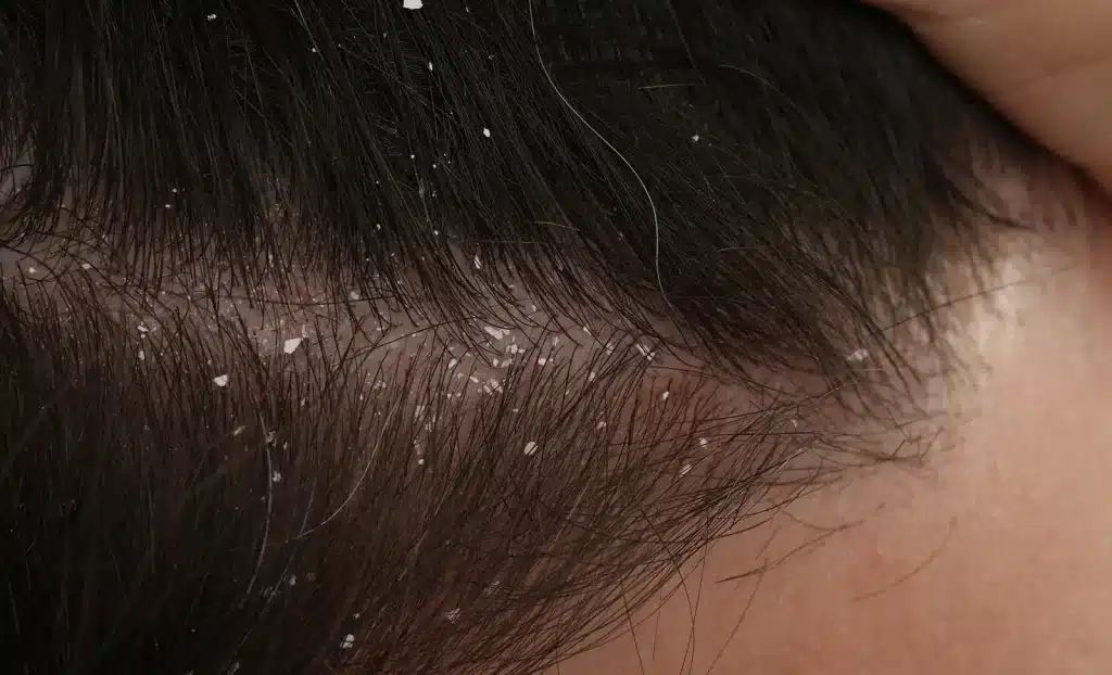 Dandruff and hair loss