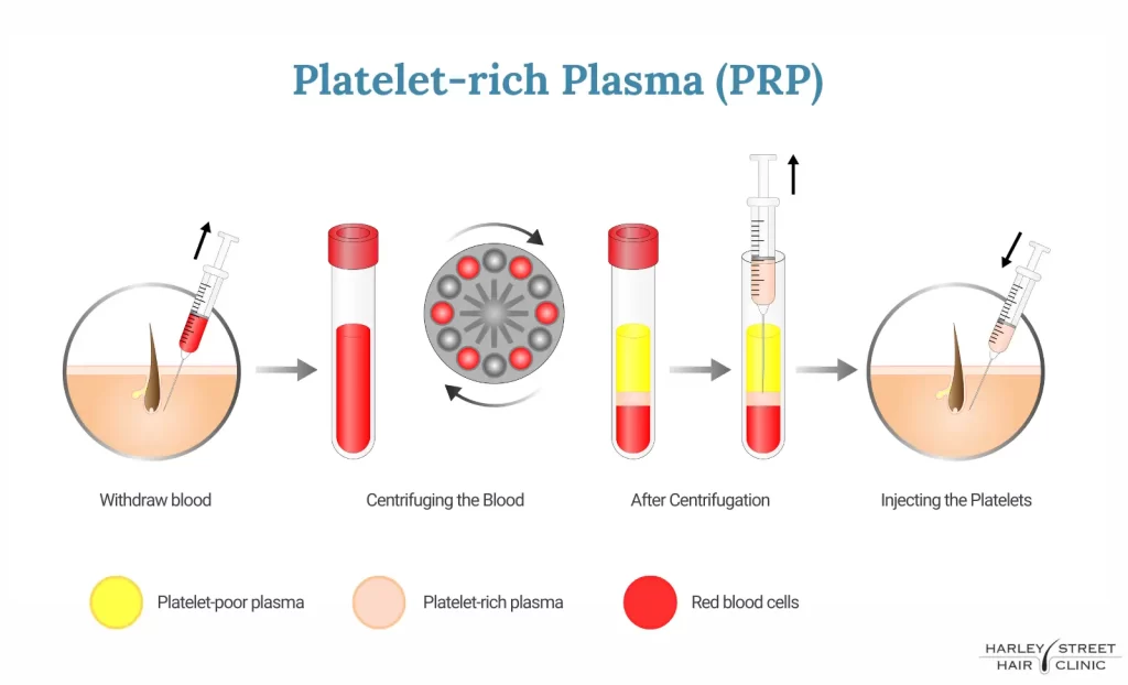 What is PRP for hair loss
