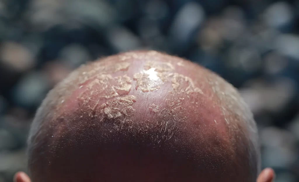 Sunburn on the scalp 