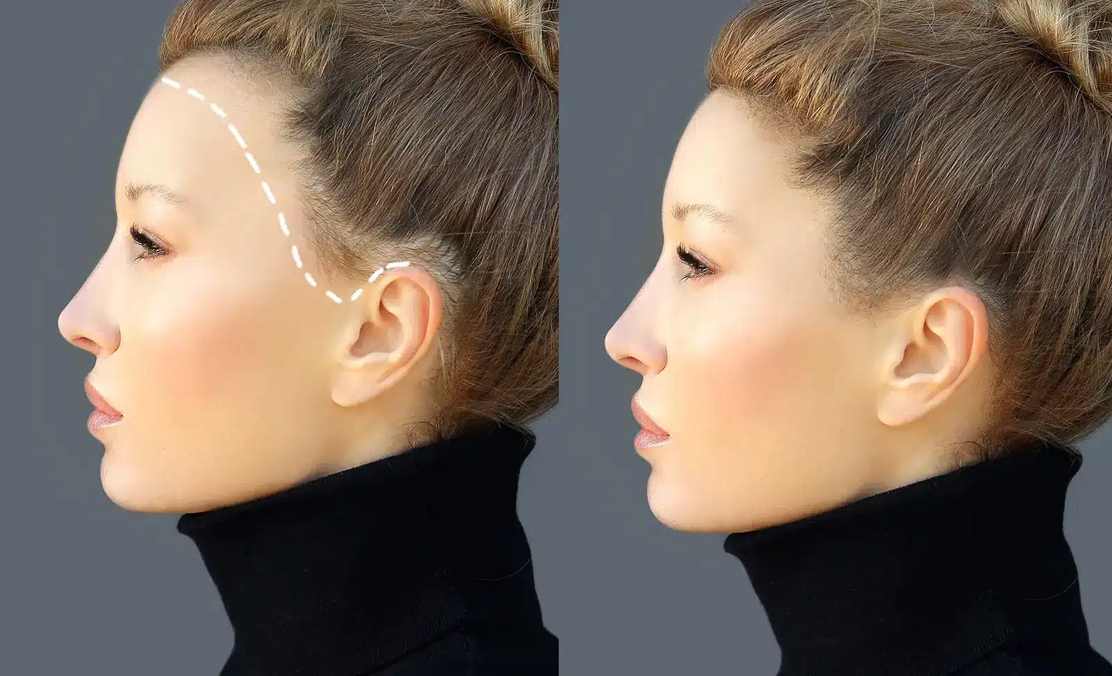 Before and after forehead reduction surgery