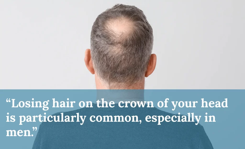 hair loss at the crown