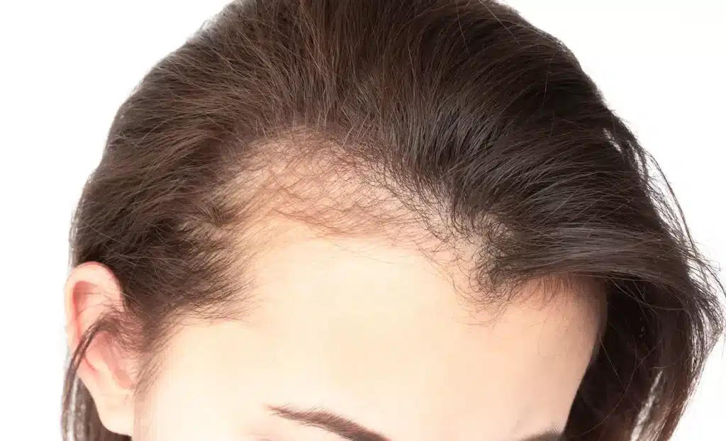 Androgenetic Alopecia hair loss 