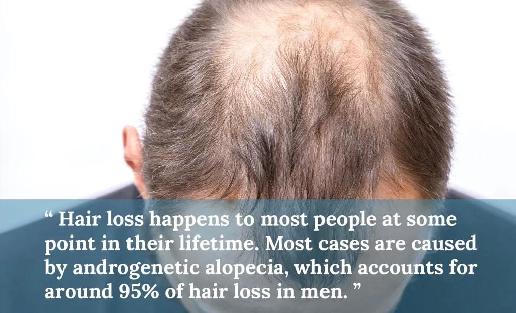 Androgenetic alopecia in men 