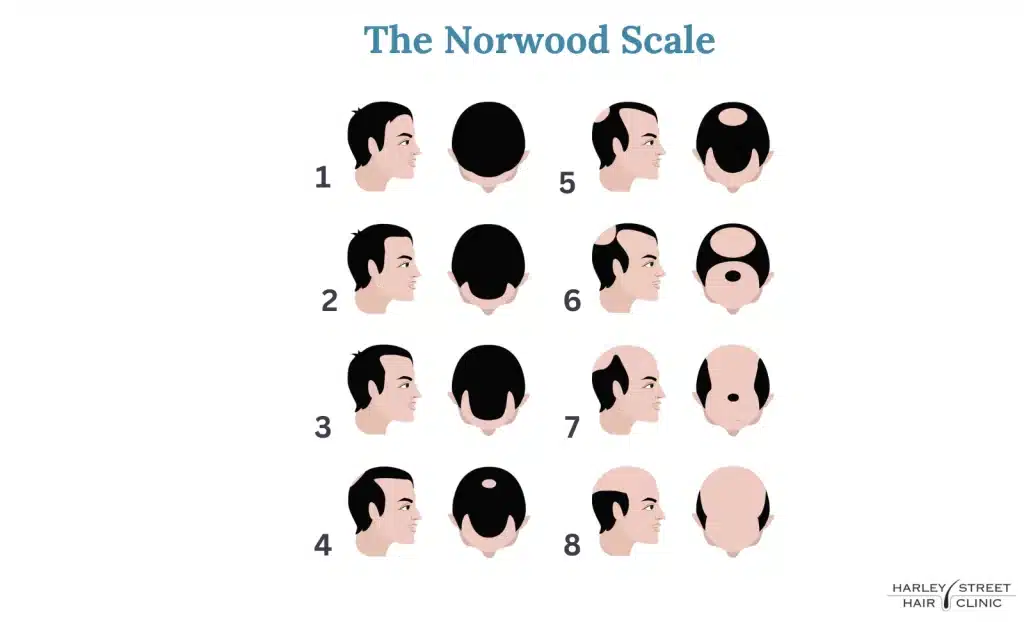 The norwood scale