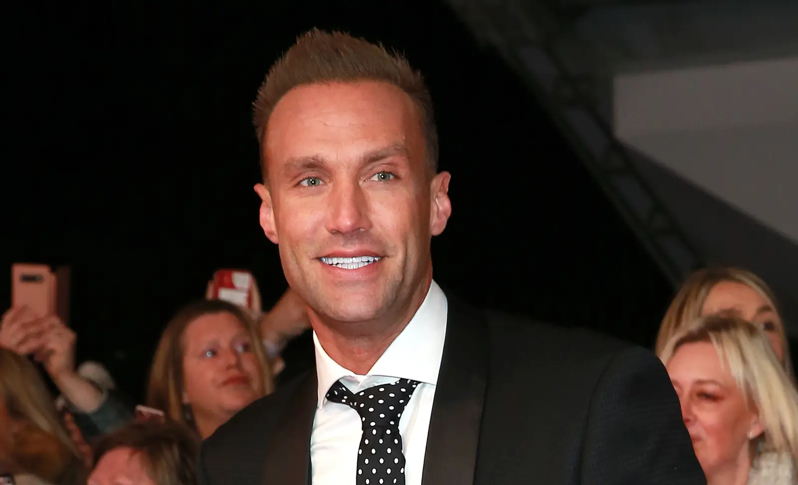 Calum Best hair transplant