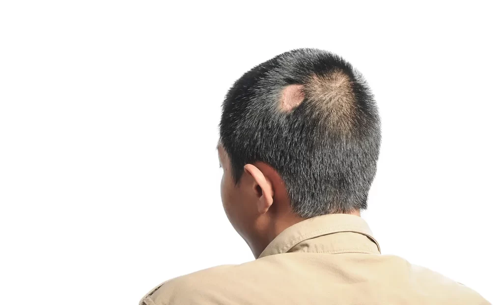 Scarring Alopecia