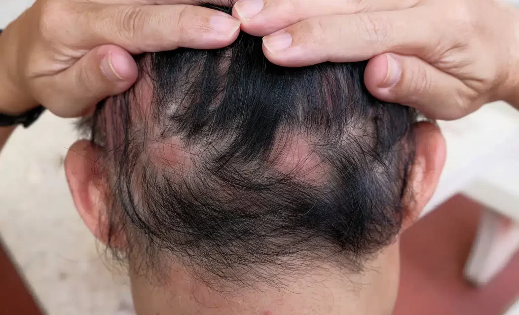 man with alopecia areata