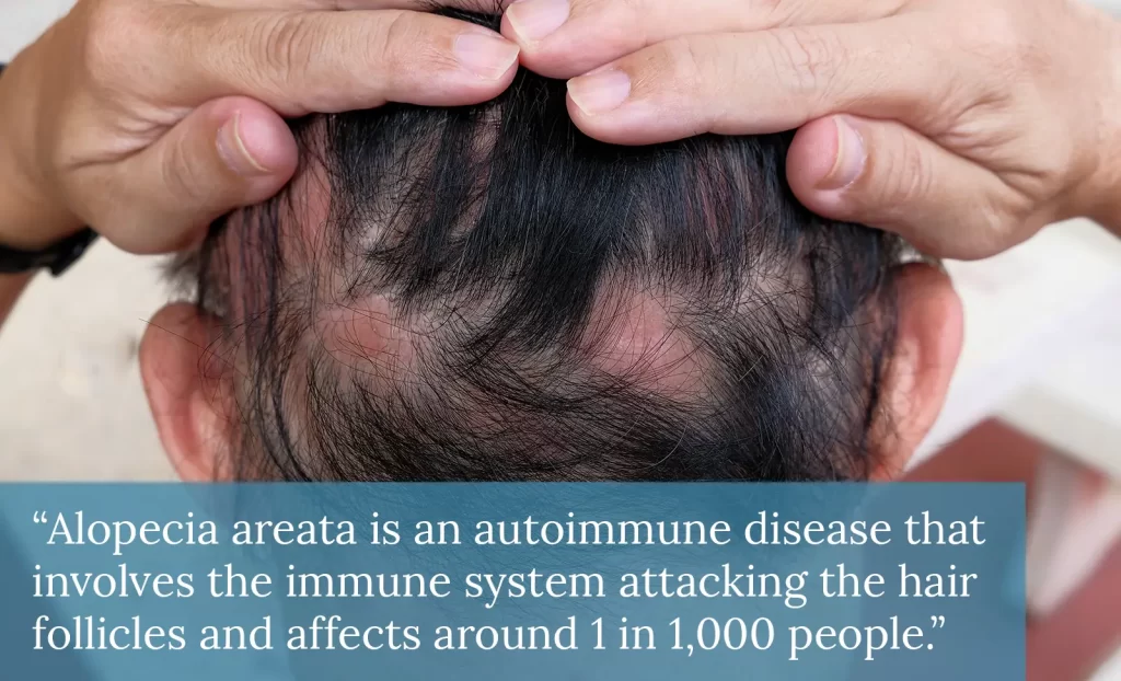 Steroid Cream for Alopecia Areta