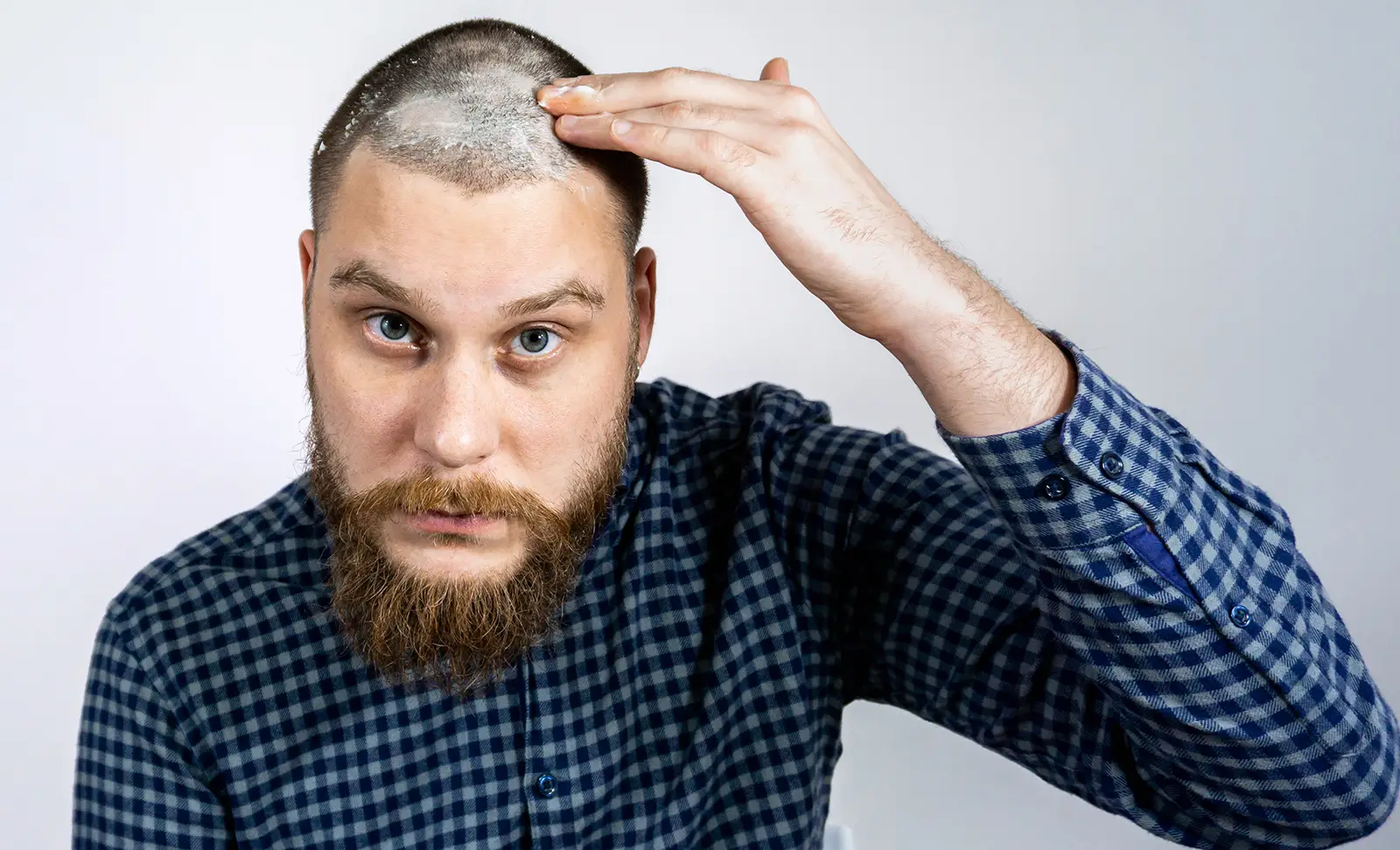 man with alopecia