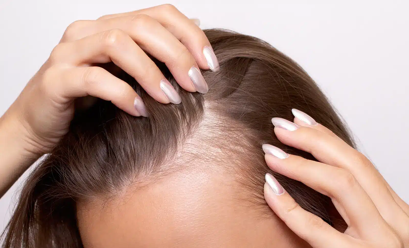 Hormones and Female Hair Loss