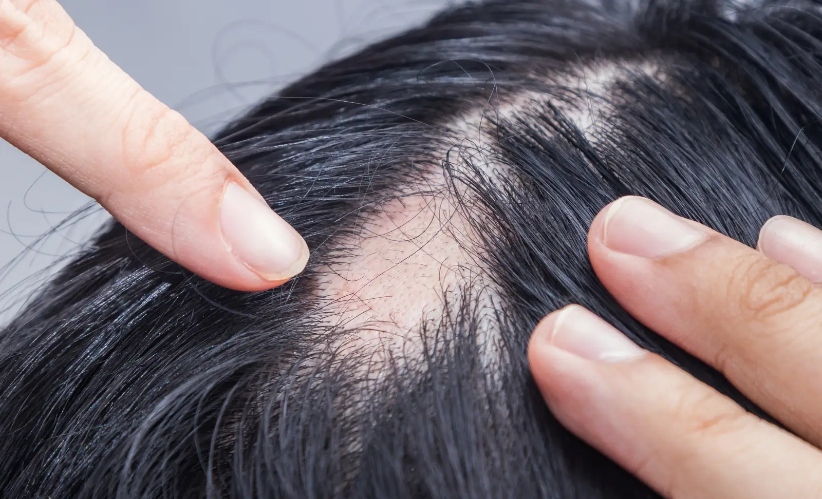 Bald patches and hair loss