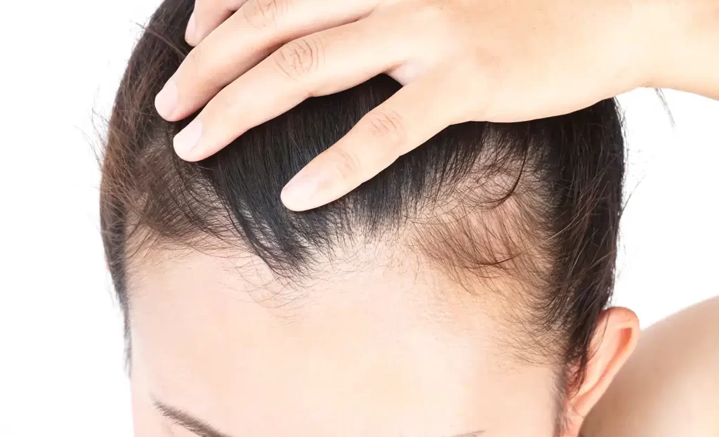 Close up of Traction Alopecia
