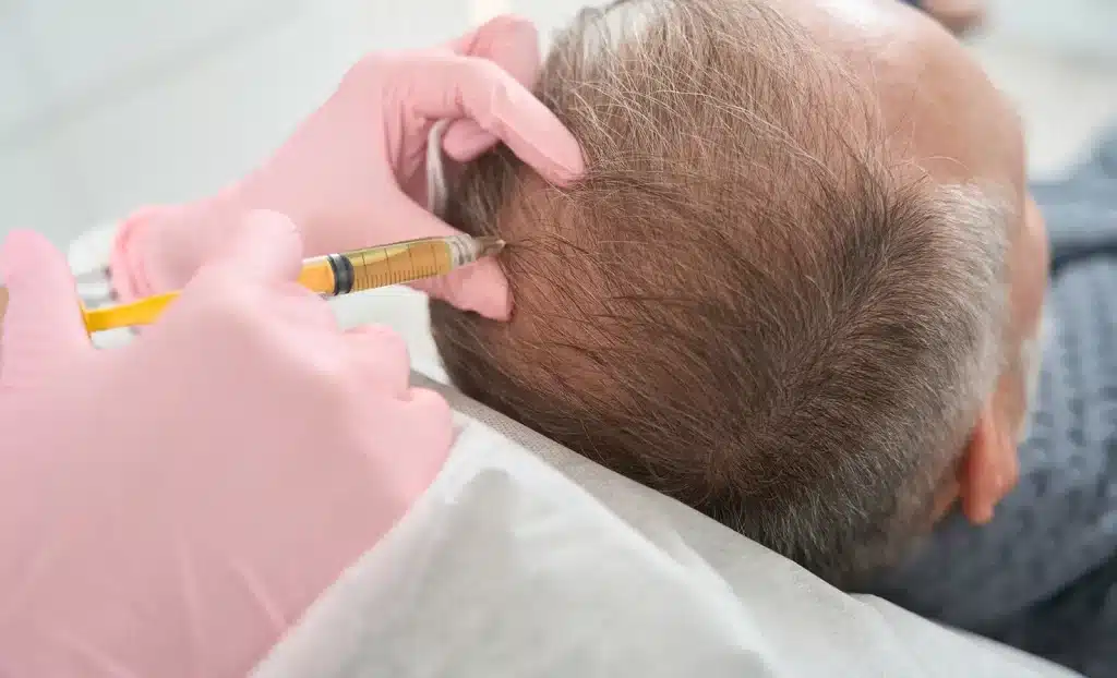  PRF for Hair Loss