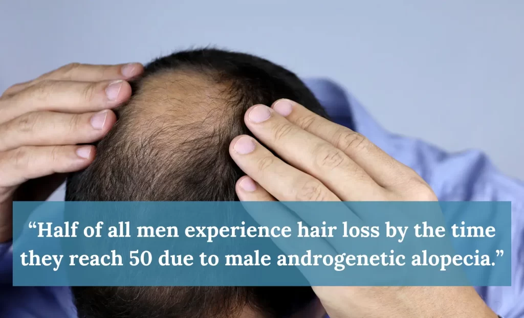 Male androgenetic alopecia