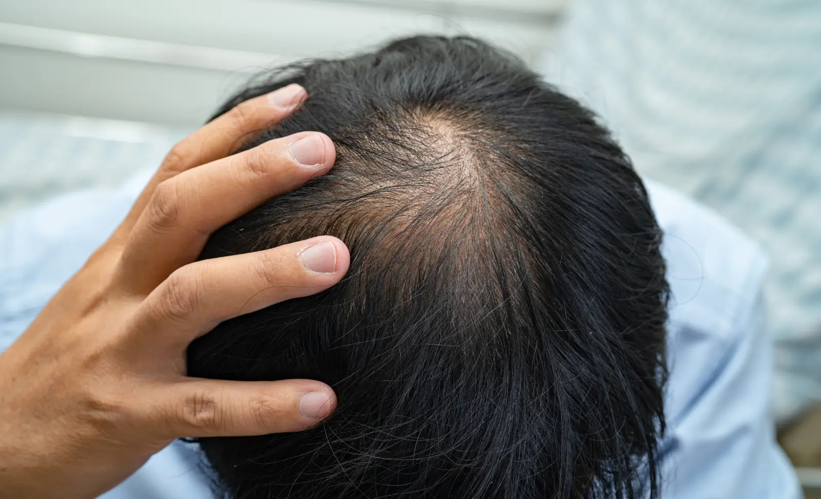 Man with androgenetic alopecia